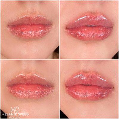 Before and after lip augmentation by Melanie Speed, APRN, NP-C