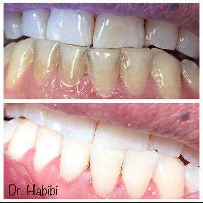 What changed this smile from what you see in the top picture vs. the bottom picture? A thorough cleaning a polish can make a big difference.