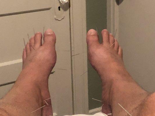 Acupuncture for neuropathy of the feet following stem cell transplant and chemotherapy.