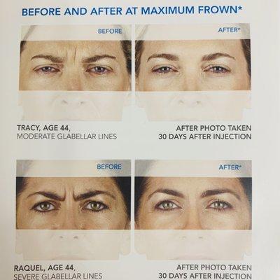 Organic botox (Xeomin) , please inquire within for a free consultation.