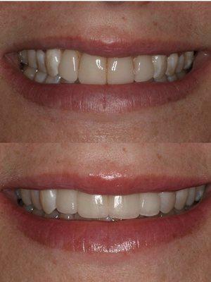 Old upper 4 veneers replaced with new veneers.