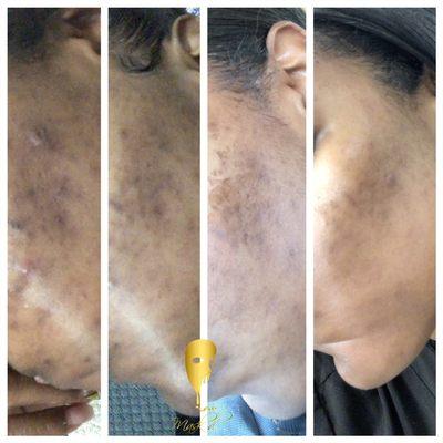 Chemical Peel & Facial Plan Results.