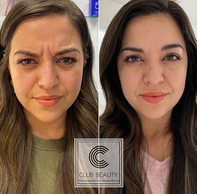 Before and after Botox on this client.