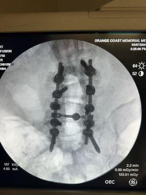 Overview of my rebuilt spine.  "Routine work" said Dr. Binder