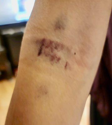 12 hrs after blood draw at Quest.