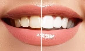 OMG teeth whitening now availible!
 book online 24/7 www.myfullblowndrybarandmakeup.com