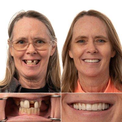 Beautiful before/after with Full Mouth Implants