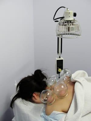 Patient receiving cupping treatment