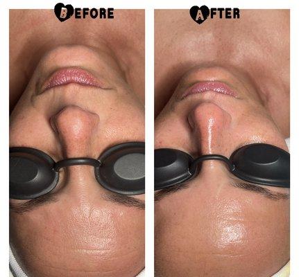 Anti aging facial