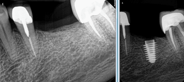 Dental Implants with cone beam technology