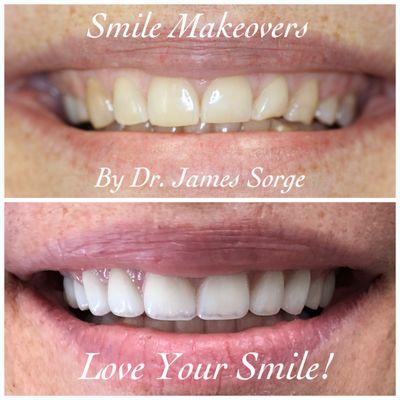 Veneers for a beautiful, updated smile.  #loveyoursmile #smilevirtualconsult #oakhollowdentistry