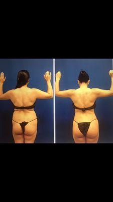 Brazilian Butt Lift. Gluteal fat transfer