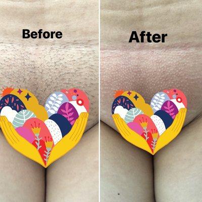 Brazilian wax / before and after