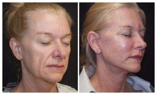 Facelift Before & After