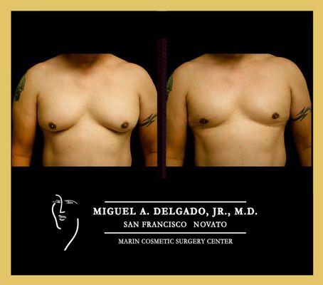 Gynecomastia- Also specialize in best facelift, mini-facelift, tummy tuck, mini-tummy tuck in Napa Valley, Sonoma County, San Francisco