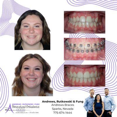 An Andrews Braces Smile Transformation