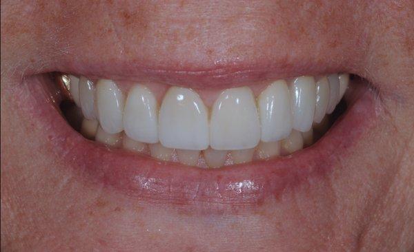 Smile MakeOver with porcelain Veneers