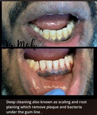 Deep cleaning can achieved with scaling and root planing