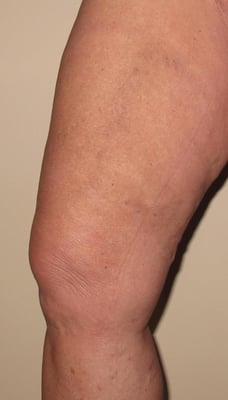 After Venefit procedure.  Treatment for varicose veins.