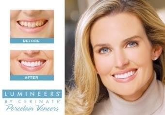 LUMINEERS®: Ultra-thin LUMINEERS are custom designed to give you the beautiful smile you've always dreamed of