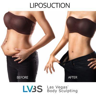 Liposuction - Before & After