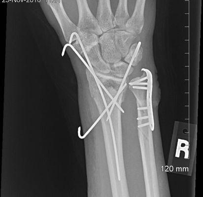 X ray of pins to be removed. Greg Herzog REFUSED to numb my hand. His uncaring nurse said no pain meds needed! It was Hell!