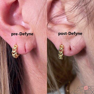 Defyne was used to restore volume to the earlobe.