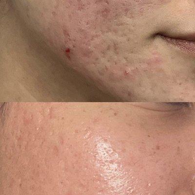 Check out this stunning transformation! 
 Witness the before and after results of our patient's Micro-needling and PRP journey.