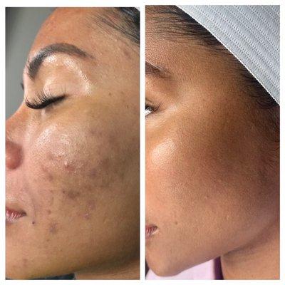 Microneedling