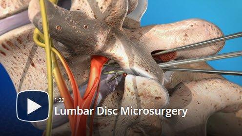 He recommended we do a microdiscectomy for my bulging disc at my L4/L5