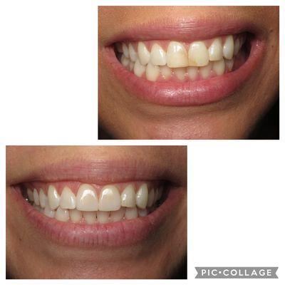 Two front veneers before and after