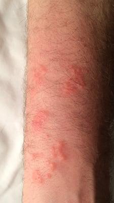 Everybody reacts differently to Bed Bug bites. From a 1-10 (10 being the most severe) this reaction is about an 8.