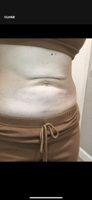 Liposuction Results: 1year post op