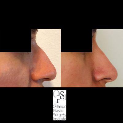 Non-surgical rhinoplasty done with the use of Restylane, an injectable filler.