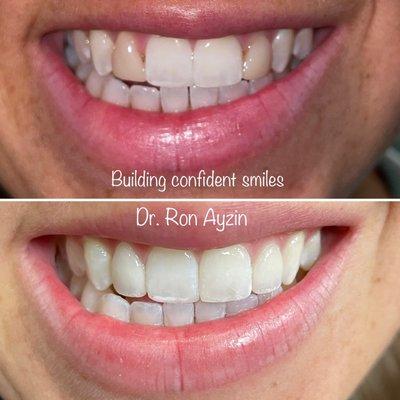 This patient didn't like her discolored teeth and the size. Fixed with 2 veneers