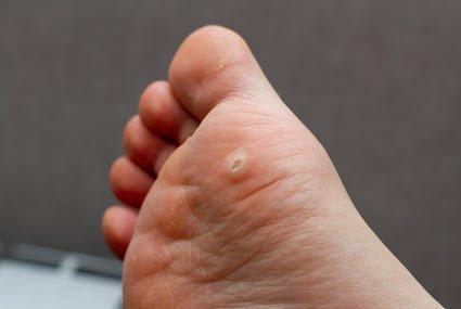 Plantars Warts on Foot