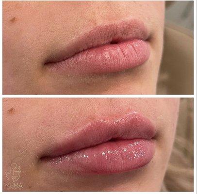 Lip filler without bruising