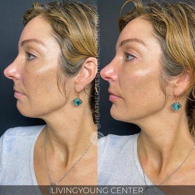 Chin and jawline filler