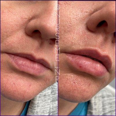 Lip Filler Smile Line Filler Profile Balancing