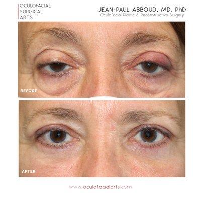 Upper Eyelid Blepharoplasty and Ptosis Repair + Lower Eyelid Blepharoplasty with Fat Repositioning