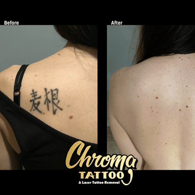 Laser Tattoo Removal