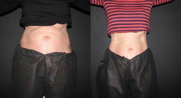 CoolSculpting at Radiance