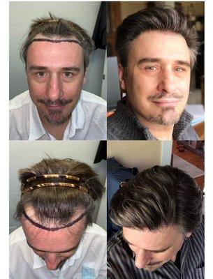 One procedure only! Life changing results!!!

check more @ https://www.greathairtransplants.com/patient/p431/franz/

Call @ 954.567.5868