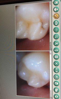 Before and after cavity drill/fill