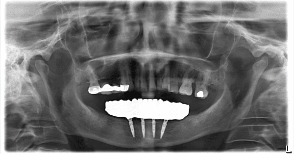 All-on-X. Extraction of all mandibular teeth(lower jaw) followed by 4 immediate implants with a full arch restoration.