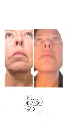 MLD Vodder technique  Facelift, chin lipo