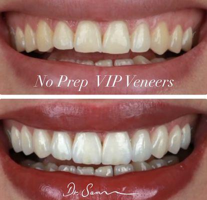 No prep VIP veneers @ discount prices.