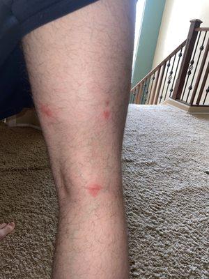 Bed bug bites