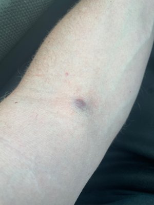 Bruised / raised injection site