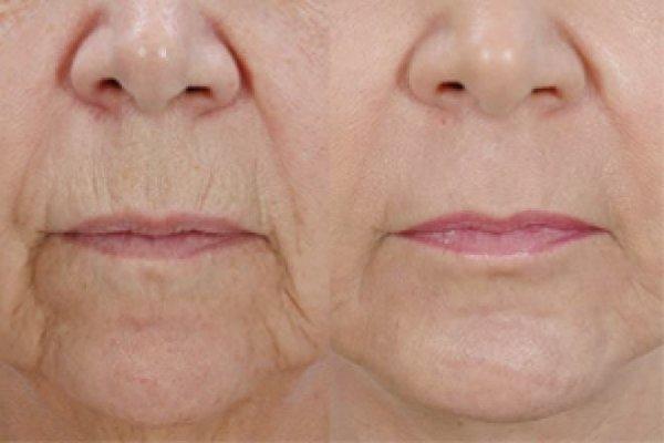 Erbium Laser Skin Resurfacing Patient Before & After